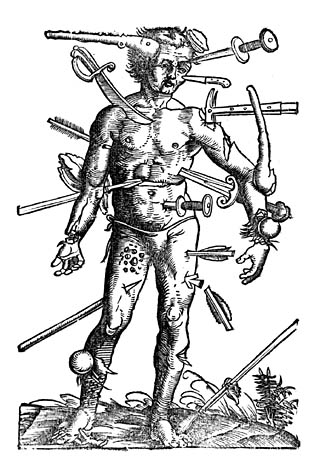Hans von Gersdorff's wound man from his Fieldbook of Wound Surgery, a woodcut print showing a truly unfortunate man suffering all then-common battlefield injuries at the same time.